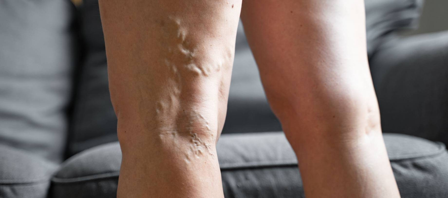 Understanding Blood Clots and Their Treatment